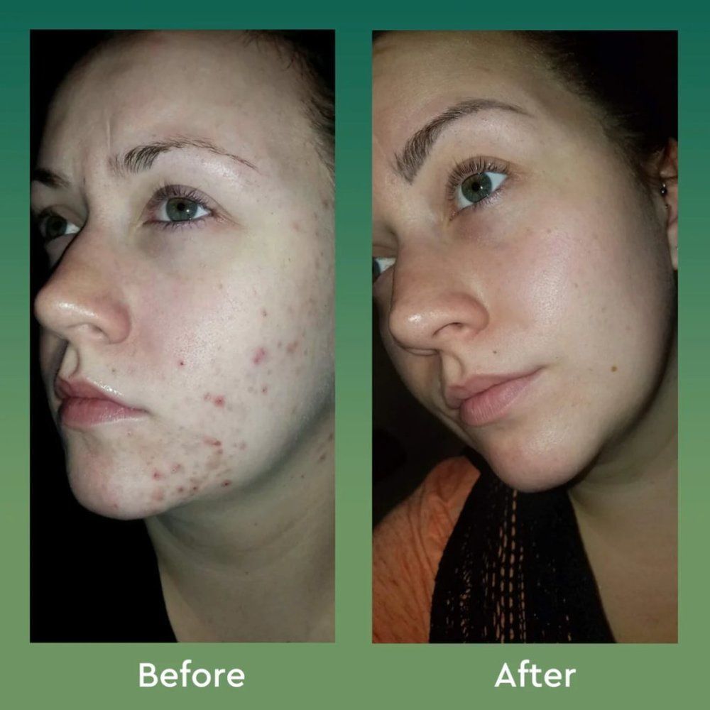 NWT bioClarity Clear Skin Routine for Acne Prone Skin NIB - Picture 5 of 11